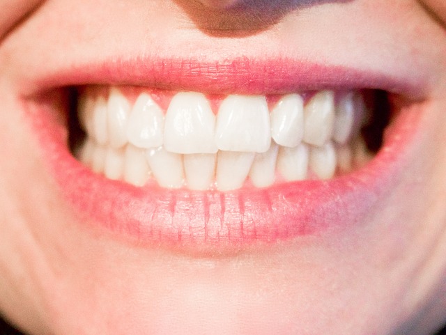 Should you whiten your teeth?