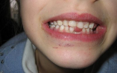 What Should I Do If My Child Knocks Out A Tooth?
