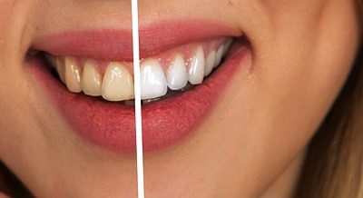 Charcoal Whitening: Is It Worth It?