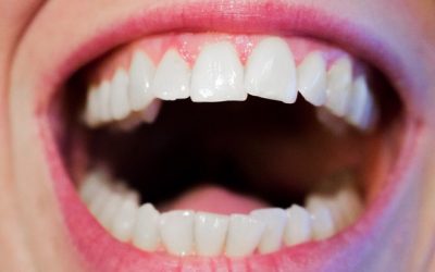 DIY Teeth Straightening Can Cause Irreversible Damage