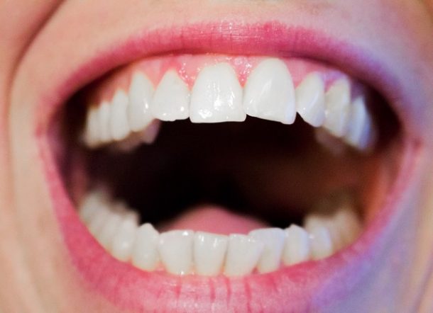 DIY Teeth Straightening Can Cause Damage | Port Pediatric Dentistry