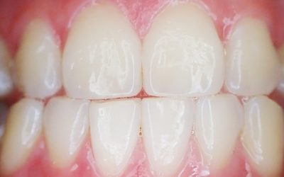 Risk Factors for Gingivitis: Part 1