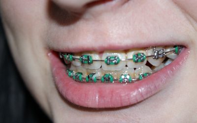 How Do I Know If My Child Needs Braces?