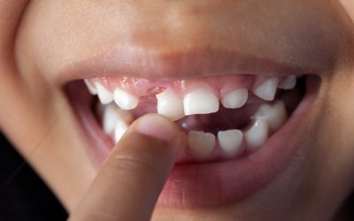 6 Tips for Dealing With a Loose Tooth