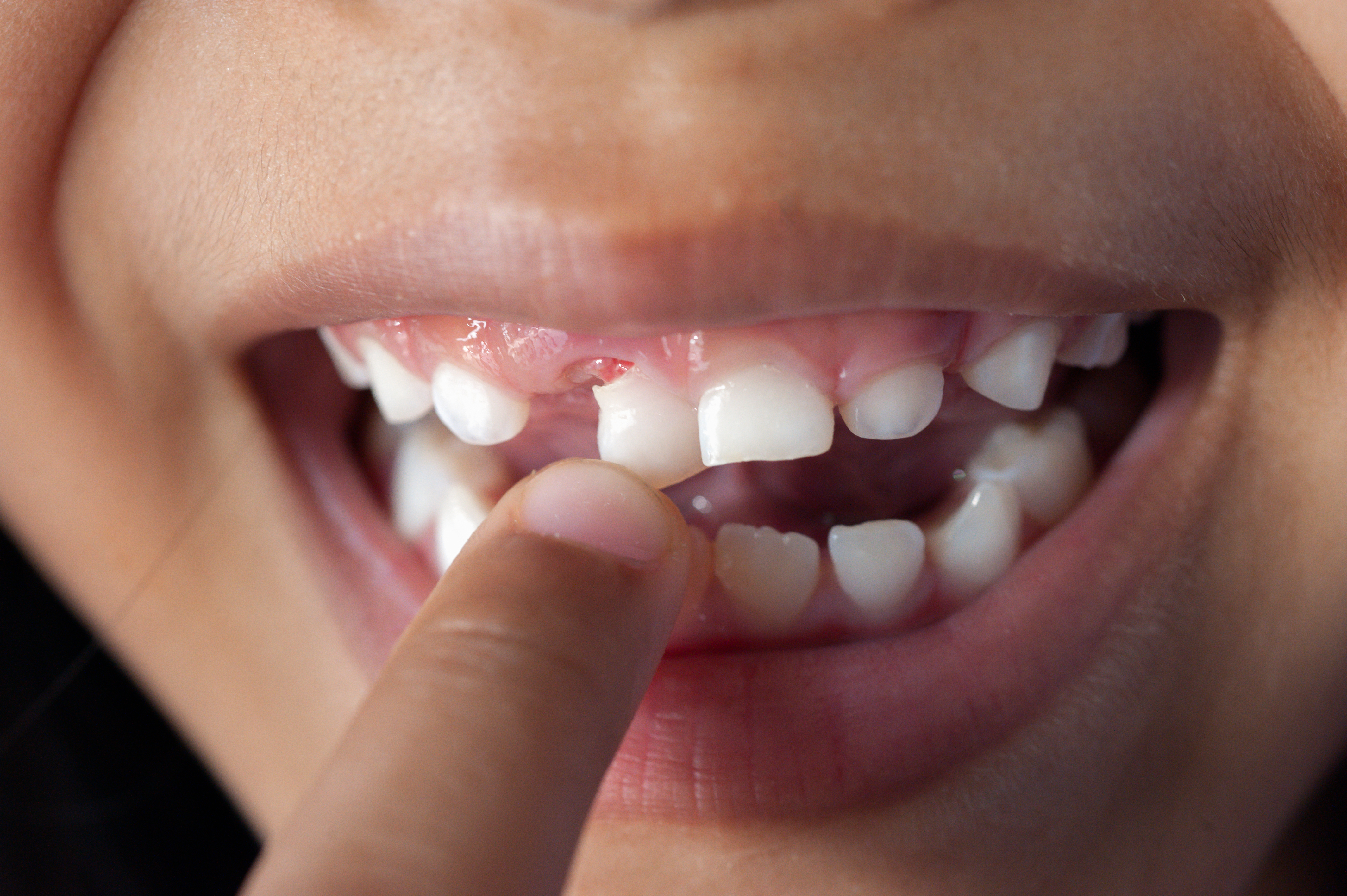 how to pull a baby tooth out without it hurting