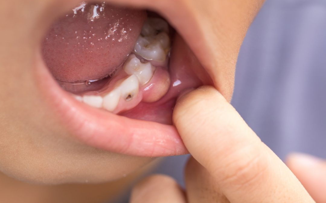 6 Facts You Didn’t Know About Cavities